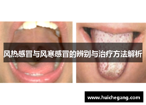 风热感冒与风寒感冒的辨别与治疗方法解析 风热感冒与风寒感冒的辨别与治疗方法解析